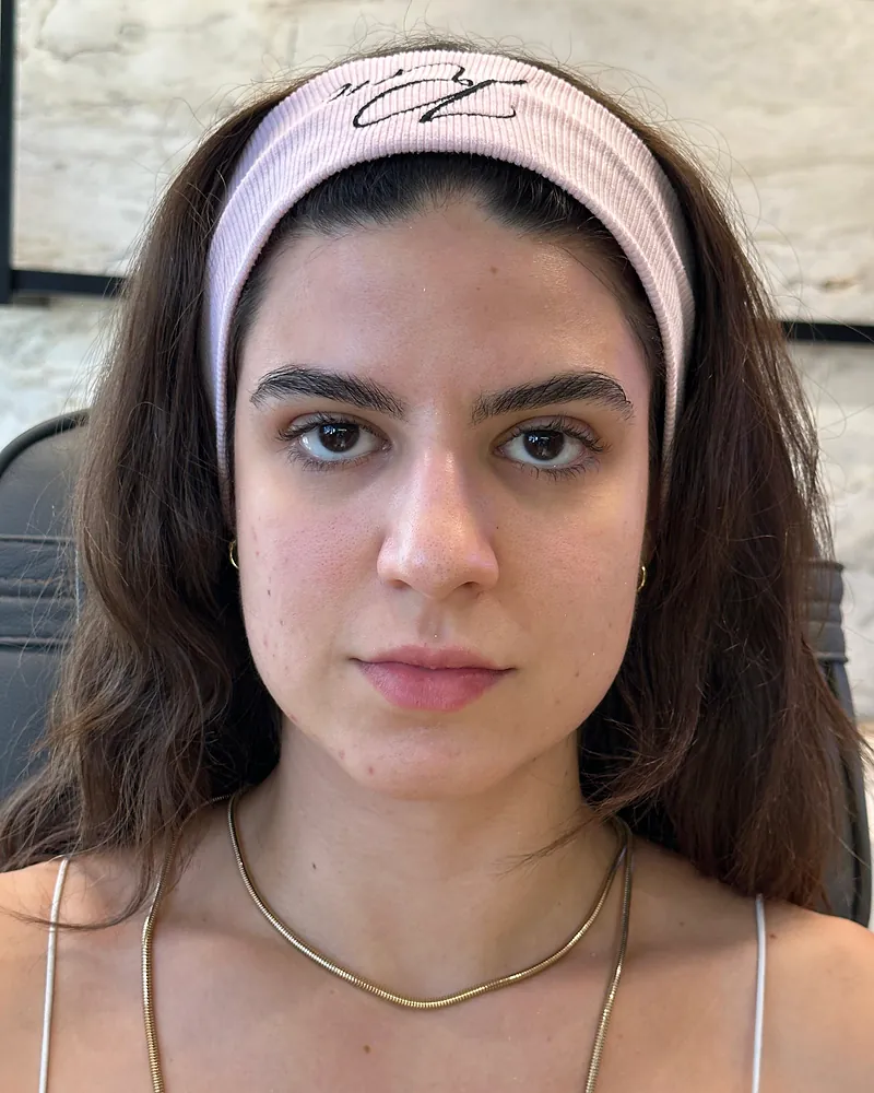 Antes da harmonização facial — vista frontal, caso 1