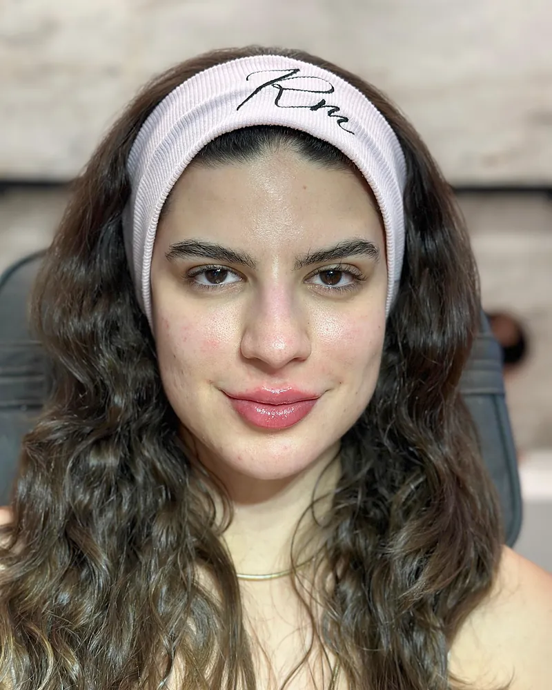 Depois da harmonização facial — vista frontal, caso 1