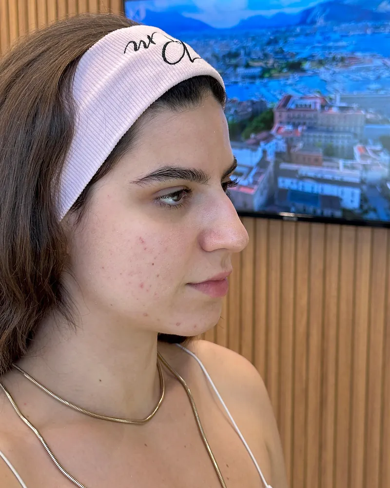 Antes da harmonização facial — vista de perfil, caso 1