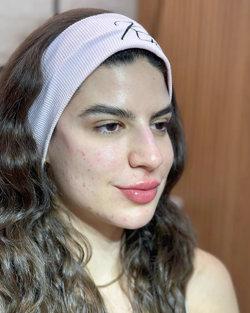Depois da harmonização facial — vista de perfil, caso 1