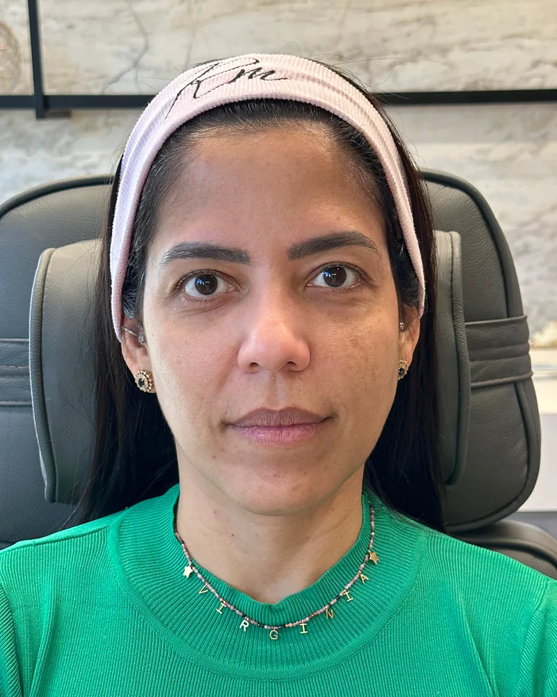 Antes da harmonização facial — vista frontal, caso 2