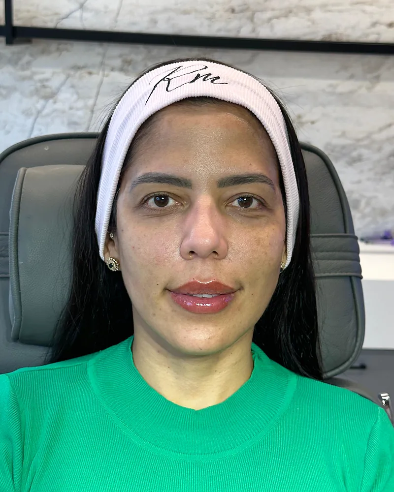 Depois da harmonização facial — vista frontal, caso 2