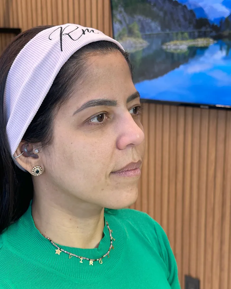 Antes da harmonização facial — vista de perfil, caso 2