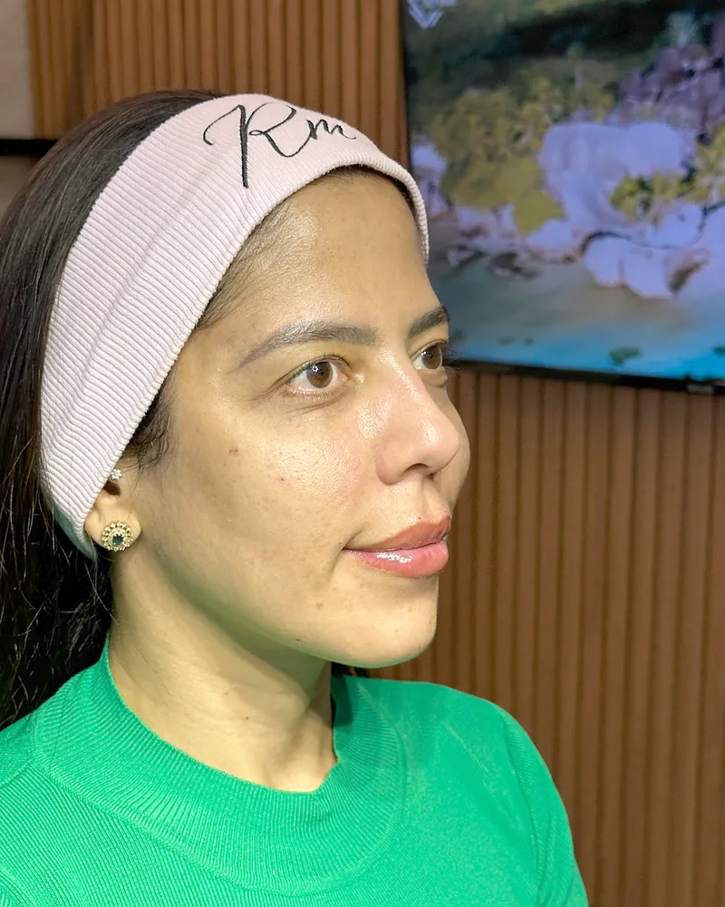 Depois da harmonização facial — vista de perfil, caso 2