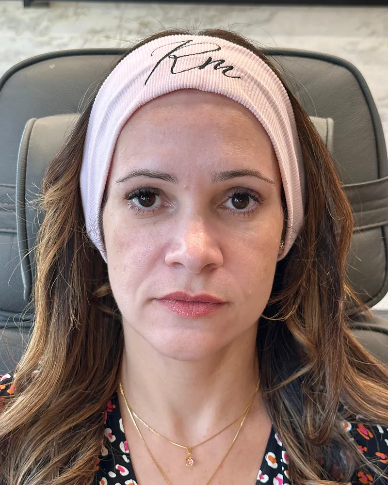 Antes da harmonização facial — vista frontal, caso 3