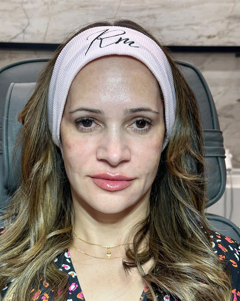 Depois da harmonização facial — vista frontal, caso 3