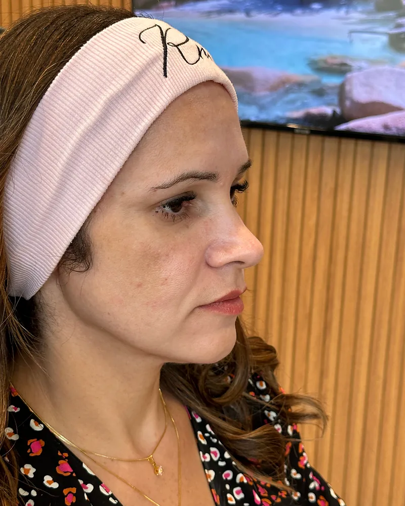 Antes da harmonização facial — vista de perfil, caso 3