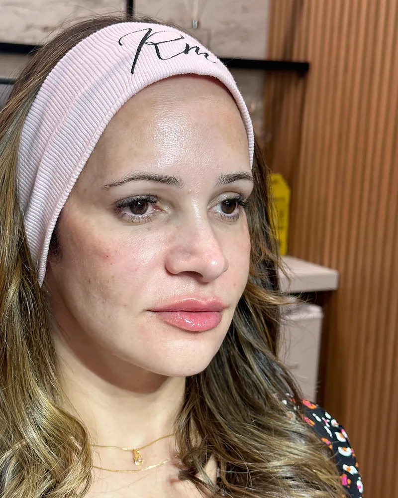 Depois da harmonização facial — vista de perfil, caso 3